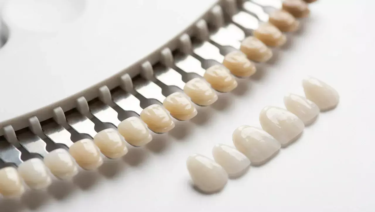 Vergleich Bleaching und Veneers - Zahnfarben-Skala und Keramik-Verblendschalen, Zahnarzt München-Neuhausen