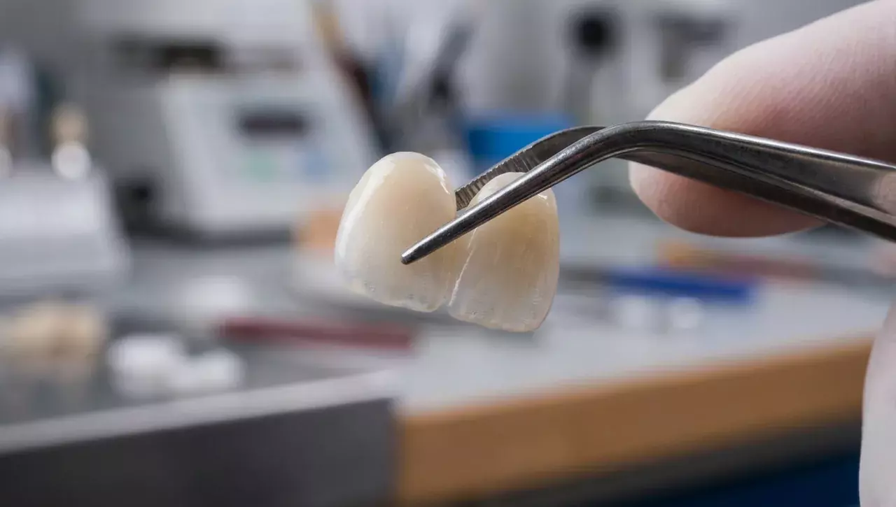 Keramik-Veneers (Verblendschalen) für natürlich schöne Frontzähne - Zahnarzt München-Neuhausen
