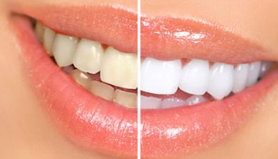 Vorher-/Nachher-Vergleich von Zahnaufhellung Zahnarzt München